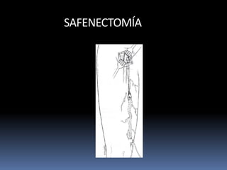 SAFENECTOMÍA
 
