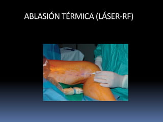 ABLASIÓN TÉRMICA (LÁSER-RF)
 