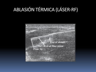 ABLASIÓN TÉRMICA (LÁSER-RF)
 