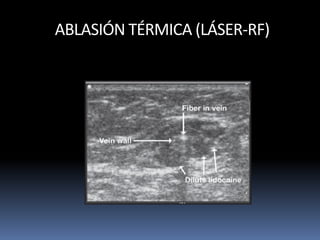 ABLASIÓN TÉRMICA (LÁSER-RF)
 
