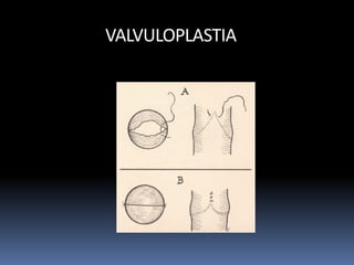 VALVULOPLASTIA
 