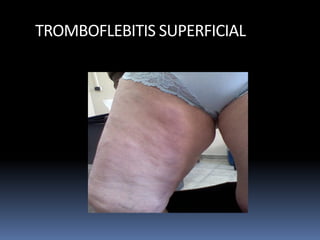 TROMBOFLEBITIS SUPERFICIAL
 