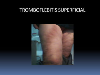 TROMBOFLEBITIS SUPERFICIAL
 