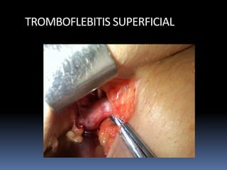 TROMBOFLEBITIS SUPERFICIAL
 
