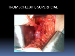 TROMBOFLEBITIS SUPERFICIAL
 