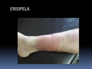 ERISIPELA
 