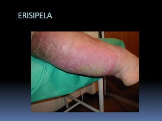 ERISIPELA
 