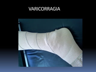 VARICORRAGIA
 