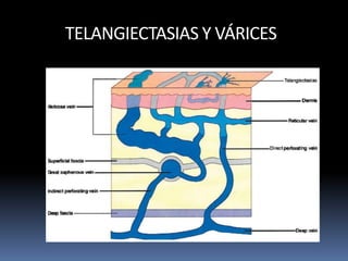 TELANGIECTASIAS Y VÁRICES
 