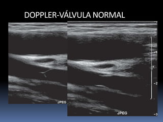 DOPPLER-VÁLVULA NORMAL
 