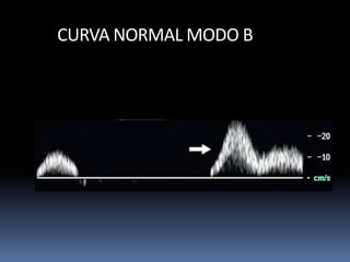 CURVA NORMAL MODO B
 