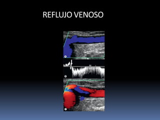 REFLUJO VENOSO
 