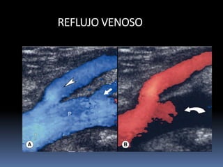 REFLUJO VENOSO
 