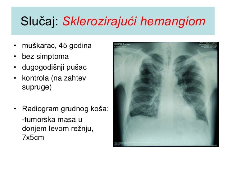 Karcinoid pluća