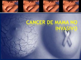 CANCER DE MAMA NO
INVASIVO
 