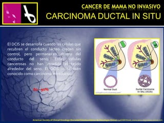 CARCINOMA DUCTAL IN SITU
CANCER DE MAMA NO INVASIVO
El DCIS se desarrolla cuando las células que
recubren el conducto lácteo crecen sin
control, pero permanecen dentro del
conducto del seno. Estas células
cancerosas no han invadido el tejido
alrededor del seno. El DCIS — también
conocido como carcinoma intraductal.
80 - 90%
American Society of Clinical Oncology (Sociedad Estadounidense de Oncología Clínica) 2318 Mill Road, www.asco.org | www.cancer.net.
 