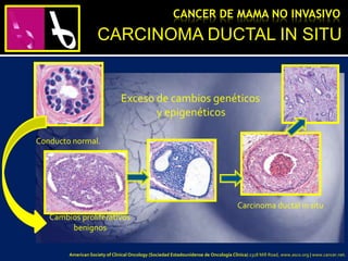 Conducto normal.
Cambios proliferativos
benignos
Carcinoma ductal in situ
Exceso de cambios genéticos
y epigenéticos
CARCINOMA DUCTAL IN SITU
CANCER DE MAMA NO INVASIVO
American Society of Clinical Oncology (Sociedad Estadounidense de Oncología Clínica) 2318 Mill Road, www.asco.org | www.cancer.net.
 