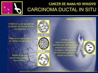 Diferentes tipos de DCIS
Cribiforme es una agrupación
de células con huecos (como
una esponja). >
Sólido es una agrupación
de células sin espacios.
Papilar se ve como
crecimientos grandes en
forma de flor. >
Comedo, el
centro de los conductos
está lleno de células muertas
(necrosis) lo cual lo hace
ver blanco. Este es el tipo
de DCIS más agresivo y de
rápido crecimiento.
CARCINOMA DUCTAL IN SITU
CANCER DE MAMA NO INVASIVO
American Society of Clinical Oncology (Sociedad Estadounidense de Oncología Clínica) 2318 Mill Road, www.asco.org | www.cancer.net.
 