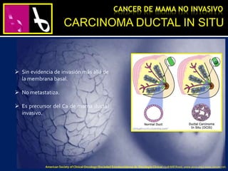  Sin evidencia de invasión más allá de
la membrana basal.
 No metastatiza.
 Es precursor del Ca de mama ductal
invasivo.
CARCINOMA DUCTAL IN SITU
CANCER DE MAMA NO INVASIVO
American Society of Clinical Oncology (Sociedad Estadounidense de Oncología Clínica) 2318 Mill Road, www.asco.org | www.cancer.net.
 