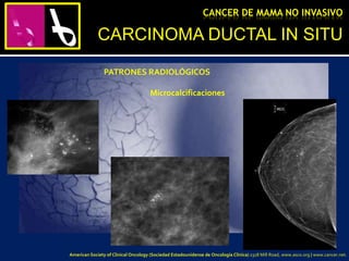 CANCER DE MAMA NO INVASIVO
PATRONES RADIOLÓGICOS
Microcalcificaciones
CARCINOMA DUCTAL IN SITU
American Society of Clinical Oncology (Sociedad Estadounidense de Oncología Clínica) 2318 Mill Road, www.asco.org | www.cancer.net.
 