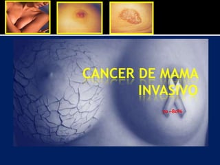 CANCER DE MAMA
INVASIVO
70 –80%
 