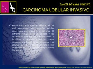 CARCINOMA LOBULAR INVASIVO
CANCER DE MAMA INVASIVO
 En su forma más típica o “clásica”, el CLI
está compuesto de pequeñas células
cancerosas que invaden el estroma. El
estroma incluye el tejido adiposo y los
ligamentos que rodean los conductos y
lobulillos y también rodea los vasos
sanguíneos y linfáticos de la mama. Las
células del CLI clásico generalmente
invaden el estroma siguiendo un patrón de
fila única.
American Society of Clinical Oncology (Sociedad Estadounidense de Oncología Clínica) 2318 Mill Road, www.asco.org | www.cancer.net.
 