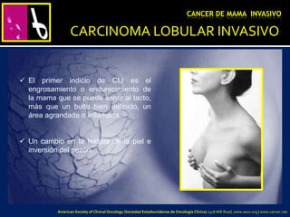 CARCINOMA LOBULAR INVASIVO
 El primer indicio de CLI es el
engrosamiento o endurecimiento de
la mama que se puede sentir al tacto,
más que un bulto bien definido, un
área agrandada o inflamada.
 Un cambio en la textura de la piel e
inversión del pezón.
CANCER DE MAMA INVASIVO
American Society of Clinical Oncology (Sociedad Estadounidense de Oncología Clínica) 2318 Mill Road, www.asco.org | www.cancer.net.
 