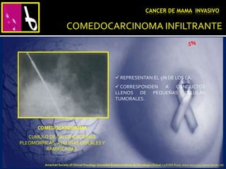 COMEDOCARCINOMA INFILTRANTE
 REPRESENTAN EL 5% DE LOS CA.
 CORRESPONDEN A CONDUCTOS
LLENOS DE PEQUEÑAS CELULAS
TUMORALES.
COMEDOCARCINOMA
CUMULO DE CALCIFICACIONES
PLEOMORFICAS, ALGUNAS LINEALESY
RAMIFICADAS.
CANCER DE MAMA INVASIVO
5%
American Society of Clinical Oncology (Sociedad Estadounidense de Oncología Clínica) 2318 Mill Road, www.asco.org | www.cancer.net.
 