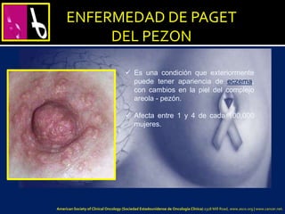 ENFERMEDAD DE PAGET
DEL PEZON
 Es una condición que exteriormente
puede tener apariencia de eczema,
con cambios en la piel del complejo
areola - pezón.
 Afecta entre 1 y 4 de cada 100,000
mujeres.
American Society of Clinical Oncology (Sociedad Estadounidense de Oncología Clínica) 2318 Mill Road, www.asco.org | www.cancer.net.
 