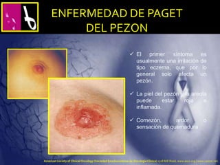  El primer síntoma es
usualmente una irritación de
tipo eczema, que por lo
general solo afecta un
pezón.
 La piel del pezón y la areola
puede estar roja e
inflamada.
 Comezón, ardor o
sensación de quemadura
ENFERMEDAD DE PAGET
DEL PEZON
American Society of Clinical Oncology (Sociedad Estadounidense de Oncología Clínica) 2318 Mill Road, www.asco.org | www.cancer.net.
 