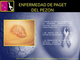  ENTRE LAS CELULAS NORMALES DE
LA EPIDERMIS APARECEN UNAS
CELULAS GRANDES, CLARAS Y MUY
CARACTERISTICAS.
 SE ASOCIA CON EL CARCINOMA
DUCTAL EN LAS MUJERES.
 EL PRONOSTICO ES BUENO SI SE
DETECTA ANTES DE QUE SE
DESARROLLE UNA MASA.
ENFERMEDAD DE PAGET
DEL PEZON
American Society of Clinical Oncology (Sociedad Estadounidense de Oncología Clínica) 2318 Mill Road, www.asco.org | www.cancer.net.
 