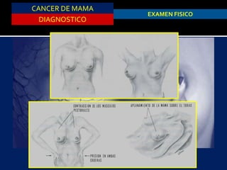 CANCER DE MAMA
DIAGNOSTICO
EXAMEN FISICO
 