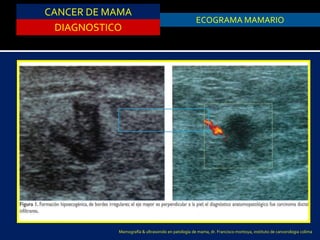 CANCER DE MAMA
DIAGNOSTICO
ASPIRACION DE QUISTESECOGRAMA MAMARIO
Mamografía & ultrasonido en patología de mama, dr. Francisco montoya, instituto de cancerologia colima
 
