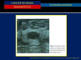 CANCER DE MAMA
DIAGNOSTICO
ASPIRACION DE QUISTESECOGRAMA MAMARIO
Mamografía & ultrasonido en patología de mama, dr. Francisco montoya, instituto de cancerologia colima
 