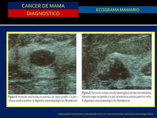 CANCER DE MAMA
DIAGNOSTICO
ASPIRACION DE QUISTESECOGRAMA MAMARIO
Mamografía & ultrasonido en patología de mama, dr. Francisco montoya, instituto de cancerologia colima
 