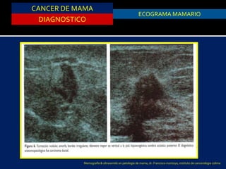 CANCER DE MAMA
DIAGNOSTICO
ASPIRACION DE QUISTESECOGRAMA MAMARIO
Mamografía & ultrasonido en patología de mama, dr. Francisco montoya, instituto de cancerologia colima
 