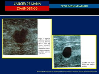 CANCER DE MAMA
DIAGNOSTICO
ASPIRACION DE QUISTESECOGRAMA MAMARIO
Mamografía & ultrasonido en patología de mama, dr. Francisco montoya, instituto de cancerologia colima
 