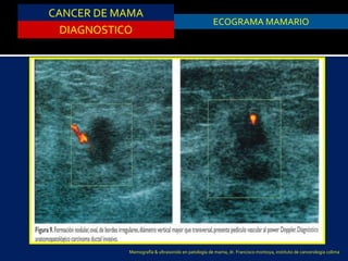 CANCER DE MAMA
DIAGNOSTICO
ASPIRACION DE QUISTESECOGRAMA MAMARIO
Mamografía & ultrasonido en patología de mama, dr. Francisco montoya, instituto de cancerologia colima
 