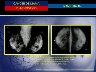 CANCER DE MAMA
DIAGNOSTICO
MAMOGRAFIA
Mamografia de escrutinio, paciente femenina de 45 anos.
A. Proyecciones medio lateral oblicuas, B. Proyecciones
craneo-caudales. Mamas con tejido moderado,
sin evidencia de alteracion, BI-RADS 1.
Mamografía & ultrasonido en patología de mama, dr. Francisco montoya, instituto de cancerologia colima
 