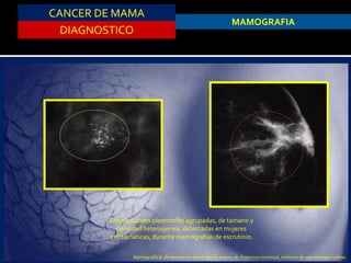 CANCER DE MAMA
DIAGNOSTICO
MAMOGRAFIA
Calcificaciones pleomorfas agrupadas, de tamano y
densidad heterogenea, detectadas en mujeres
asintomaticas, durante mamografias de escrutinio.
Mamografía & ultrasonido en patología de mama, dr. Francisco montoya, instituto de cancerologia colima
 