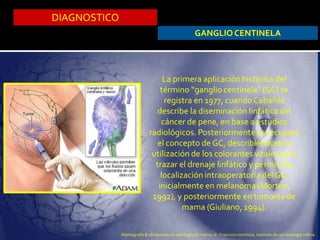 DIAGNOSTICO
GANGLIO CENTINELA
La primera aplicación histórica del
término “ganglio centinela” (GC) se
registra en 1977, cuando Cabañas
describe la diseminación linfática del
cáncer de pene, en base a estudios
radiológicos. Posteriormente se recupera
el concepto de GC, describiéndose la
utilización de los colorantes vitales para
trazar el drenaje linfático y permitir la
localización intraoperatoria del GC,
inicialmente en melanoma (Morton,
1992), y posteriormente en tumores de
mama (Giuliano, 1994).
Mamografía & ultrasonido en patología de mama, dr. Francisco montoya, instituto de cancerologia colima
 