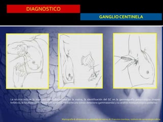 DIAGNOSTICO
GANGLIO CENTINELA
La técnica incluye la inyección del radiotrazador en la mama, la identificación del GC en la gammagrafía prequirúrgica (mapeo
linfático), la localización intraoperatoria del GC mediante una sonda detectora (gammasonda) y su análisis histopatológico posterior.
Mamografía & ultrasonido en patología de mama, dr. Francisco montoya, instituto de cancerologia colima
 