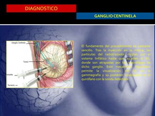 DIAGNOSTICO
GANGLIO CENTINELA
El fundamento del procedimiento es bastante
sencillo. Tras la inyección en la mama, las
partículas del radiotrazador migran por el
sistema linfático hasta que acceden al GC,
donde son atrapadas por los macrófagos de
dicho ganglio. Este mecanismo fagocitario
permite la visualización del GC en la
gammagrafía y su posterior localización en el
quirófano con la sonda detectora.
 