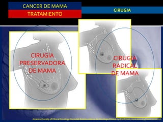 CANCER DE MAMA
TRATAMIENTO
CIRUGIA
CIRUGIA
PRESERVADORA
DE MAMA
CIRUGIA
RADICAL
DE MAMA
American Society of Clinical Oncology (Sociedad Estadounidense de Oncología Clínica) 2318 Mill Road, www.asco.org | www.cancer.net.
 