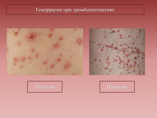 Петехии Пурпуры
Геморрагии при тромбоцитопатиях
 