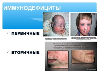  ПЕРВИЧНЫЕ
 ВТОРИЧНЫЕ
ИММУНОДЕФИЦИТЫ
 