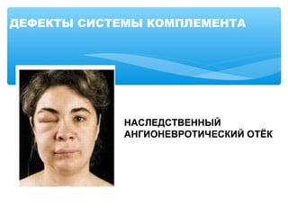 ДЕФЕКТЫ СИСТЕМЫ КОМПЛЕМЕНТА
НАСЛЕДСТВЕННЫЙ
АНГИОНЕВРОТИЧЕСКИЙ ОТЁК
 