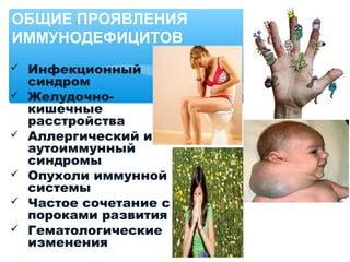  Инфекционный
синдром
 Желудочно-
кишечные
расстройства
 Аллергический и
аутоиммунный
синдромы
 Опухоли иммунной
системы
 Частое сочетание с
пороками развития
 Гематологические
изменения
ОБЩИЕ ПРОЯВЛЕНИЯ
ИММУНОДЕФИЦИТОВ
 