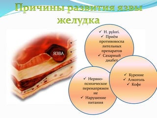  H. pylori.
 Приём
противовоспа
лительных
препаратов
 Сахарный
диабет
 Нервно-
психическое
перенапряжен
ие
 Нарушение
питания
 Курение
 Алкоголь
 Кофе
 