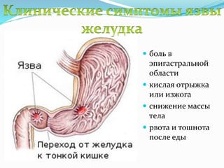  боль в
эпигастральной
области
 кислая отрыжка
или изжога
 снижение массы
тела
 рвота и тошнота
после еды
 